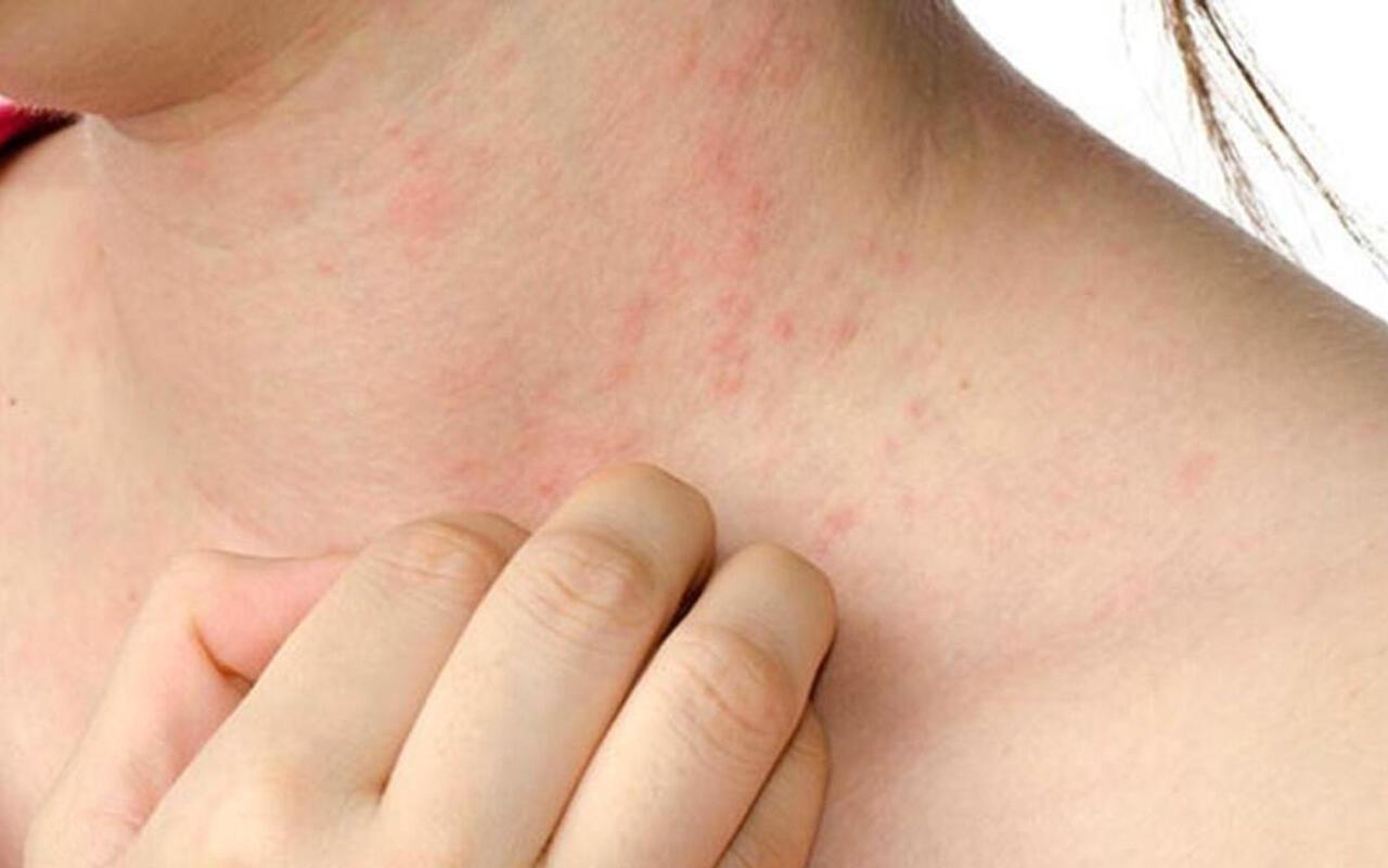 UYUZ SALGINI VE KORUNMA YOLLARI