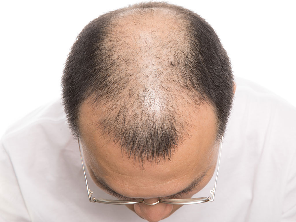 DOĞAL ÇÖZÜMLERLE SAÇLARINIZI GÜÇLENDİRİN!