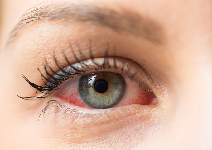 Yaz Aylarında Göz Nezlesine Dikkat!